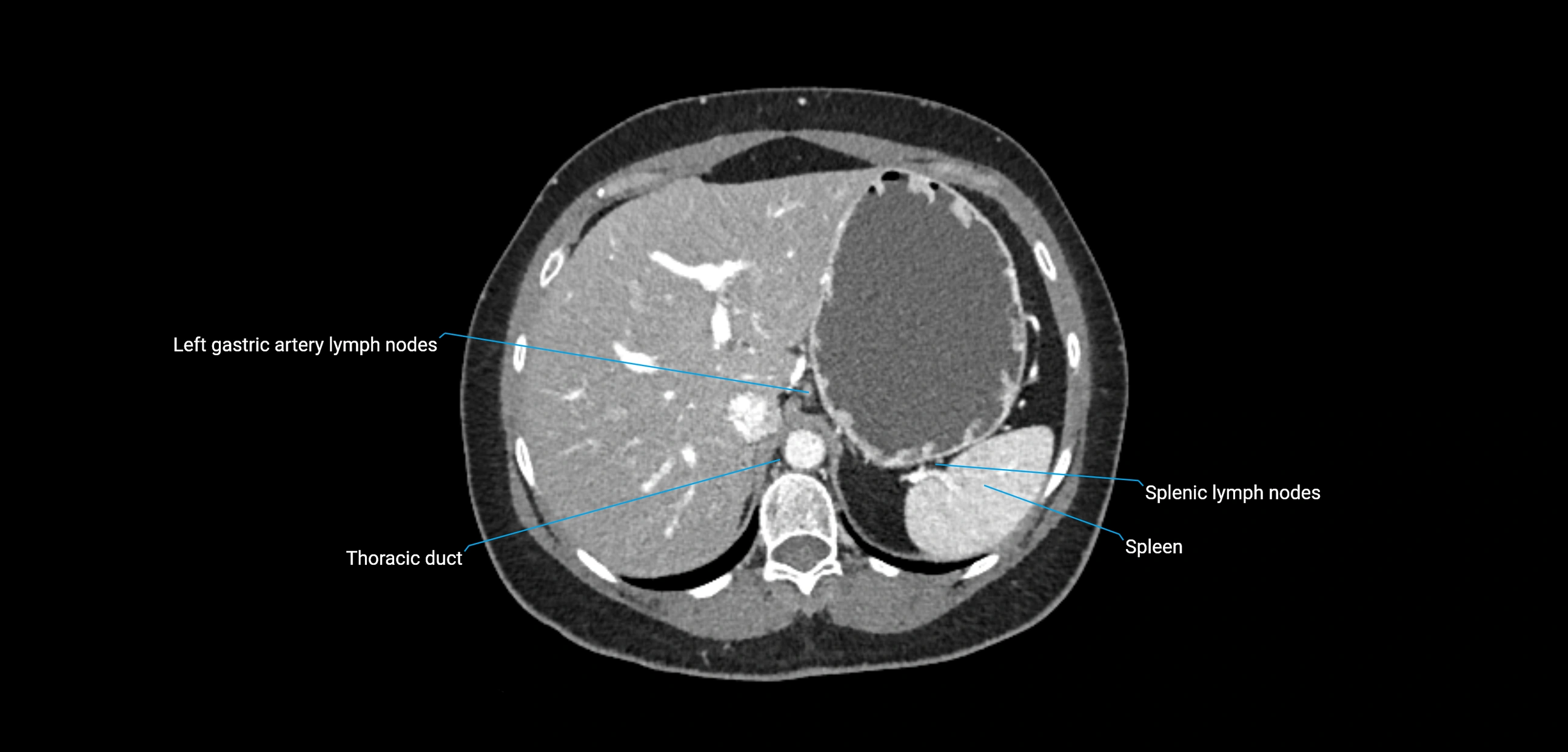 CT ct abdominal lymph nodes  axial cross sectional anatomy  enchanced radiology image -img-00002-00117.webp